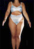 cellulite: esempio prima