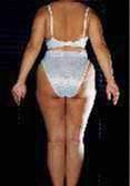 cellulite: esempio prima