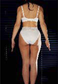 cellulite: esempio dopo terapia