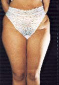 cellulite: esempio prima