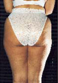 cellulite: esempio prima