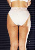 cellulite: esempio dopo terapia